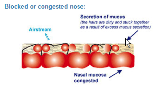 sterimar Diagram of a blocked nose showing cilia cells stuck down