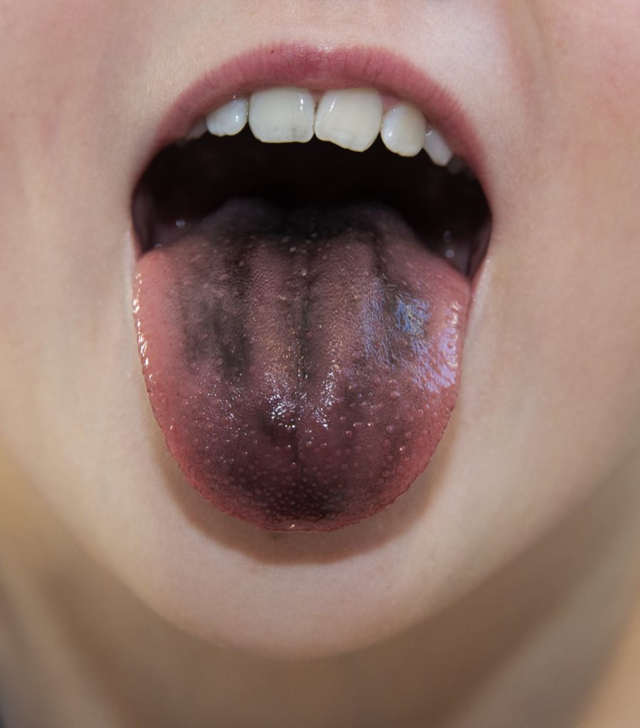 Taste buds on the tongue