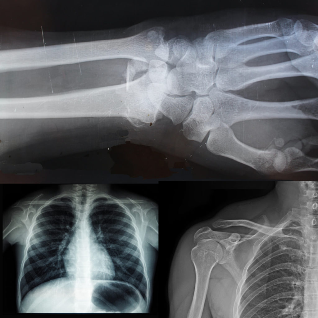 x-ray images of the hand, chest and shoulder