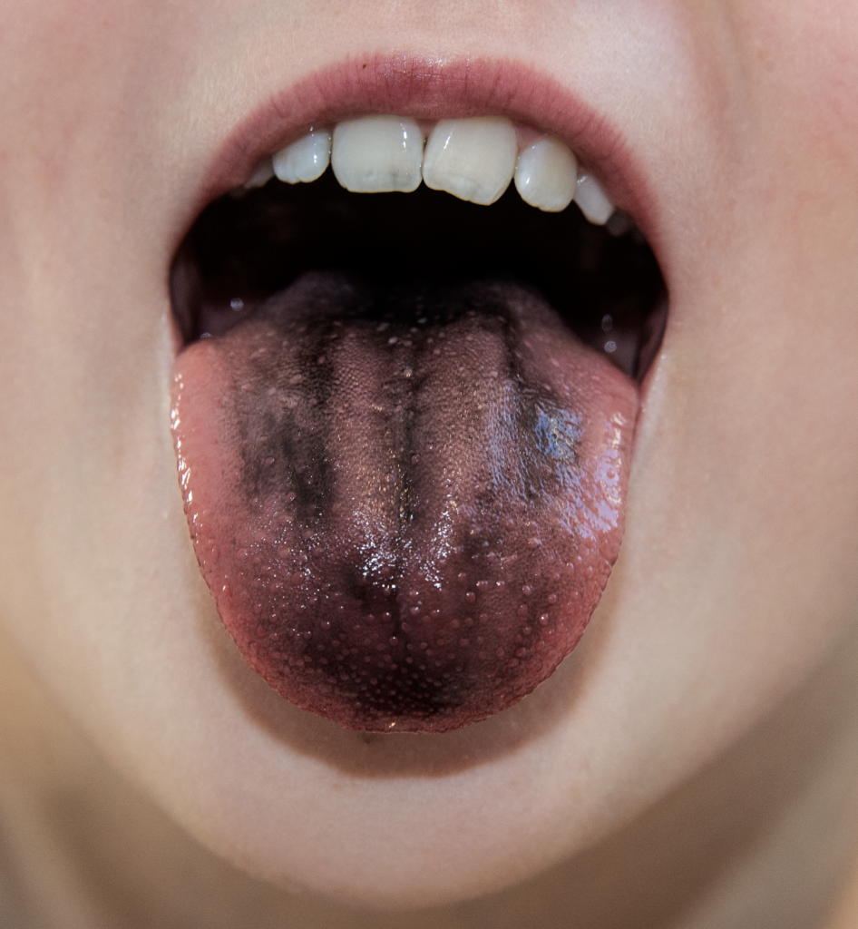 Image of tastebuds on a tongue made visible with food colouring